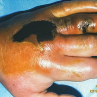 large black spot on swollen left hand after snake bite