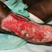 extreme skin loss on child's right foot following snake bite