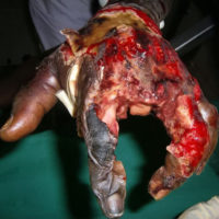 Necrosis of left hand after bite from venomous snake