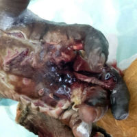 Necrosis of left hand following bite from venomous snake