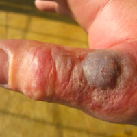 swollen pustule on thumb of left hand after bite from venomous snake