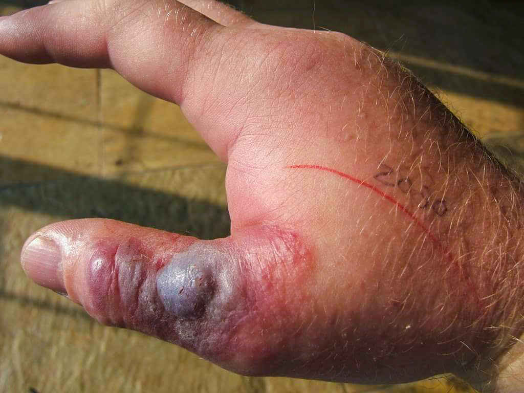 Photos of snake bites from African species. 