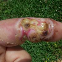 tissue damage on pointer finger after bite from Cottonmouth