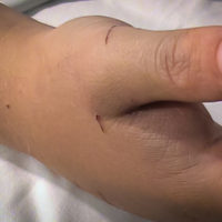 swollen hand after bite from rattlesnake