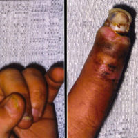 tissue damage on pointer finger after bite from pit viper