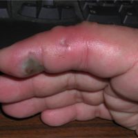 red and swollen pointer finger after bite from Egyptian cobra