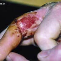 bite on finger from Monocled cobra