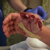 Hand fasciotomy after bite from elegant pit viper