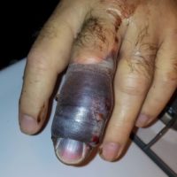 bite on finger from Western Massasauga Rattlesnake
